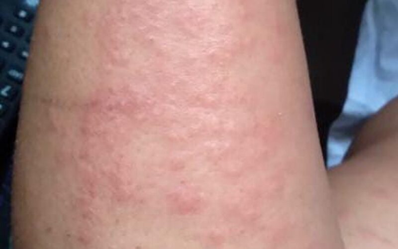 Infectologista da Paraíba não descarta associação de uso de ivermectina, com surto de coceira