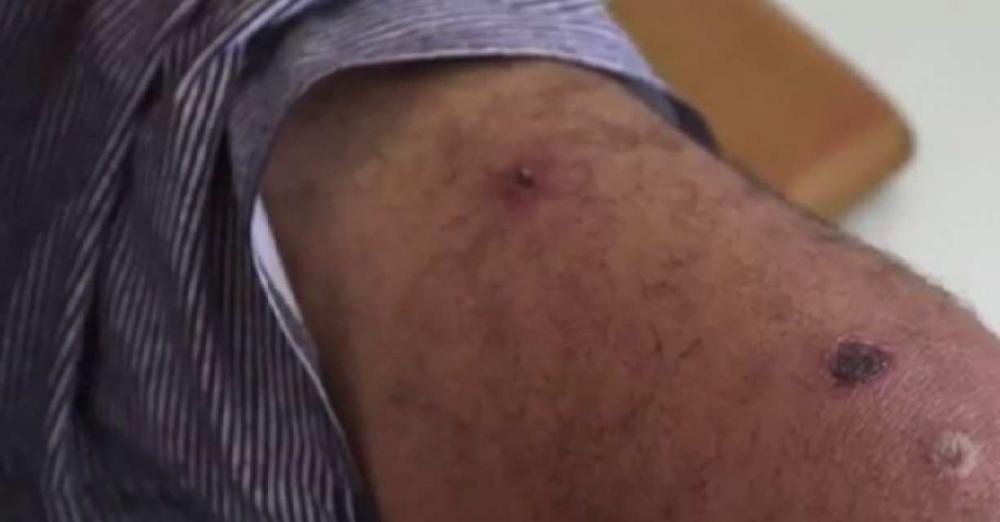 Paraíba investiga 11 casos suspeitos de coceira em 6 cidades; saiba onde e veja detalhes